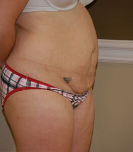 Sure signs of infection after a tummy tuck - Hourglass Tummy Tuck